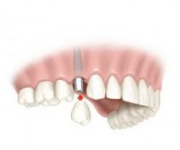 /album/fotogaleria-inicio1/implante-3-jpg/